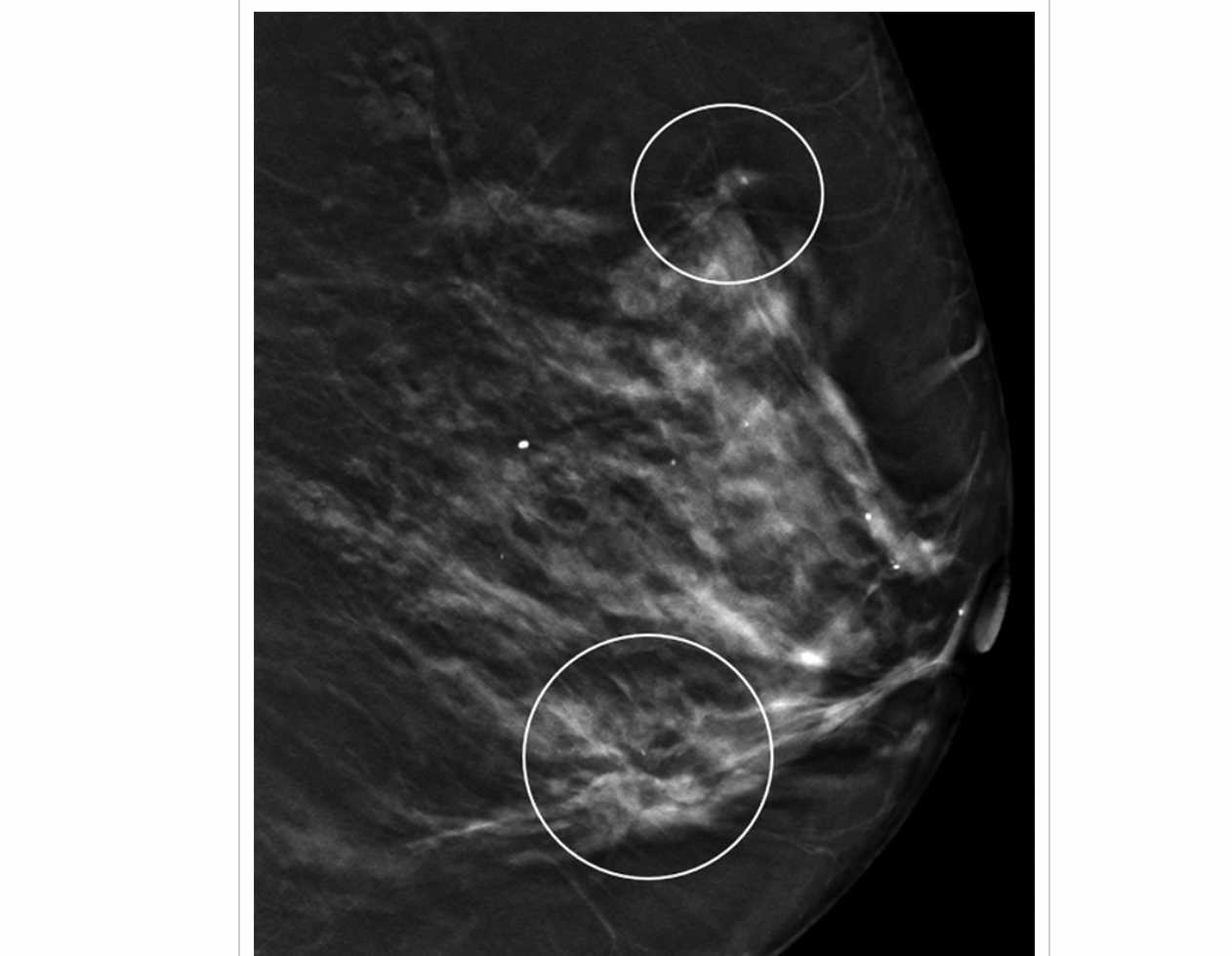 PHOTO GALLERY What does breast cancer look like on mammography